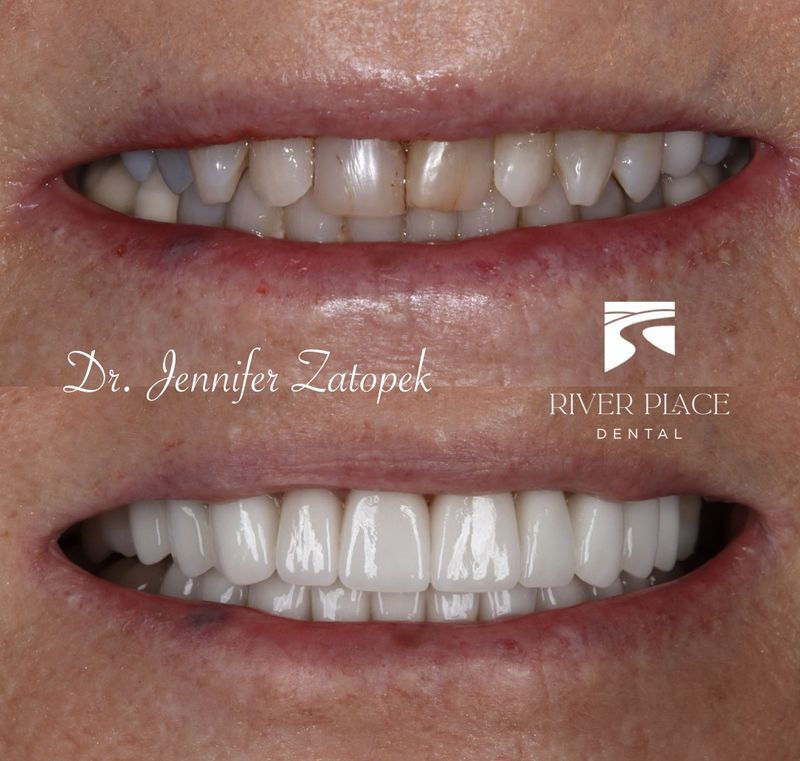 River Place Dental | CEREC   Crowns In A Day, Custom Mouthguards and Composite Bonding