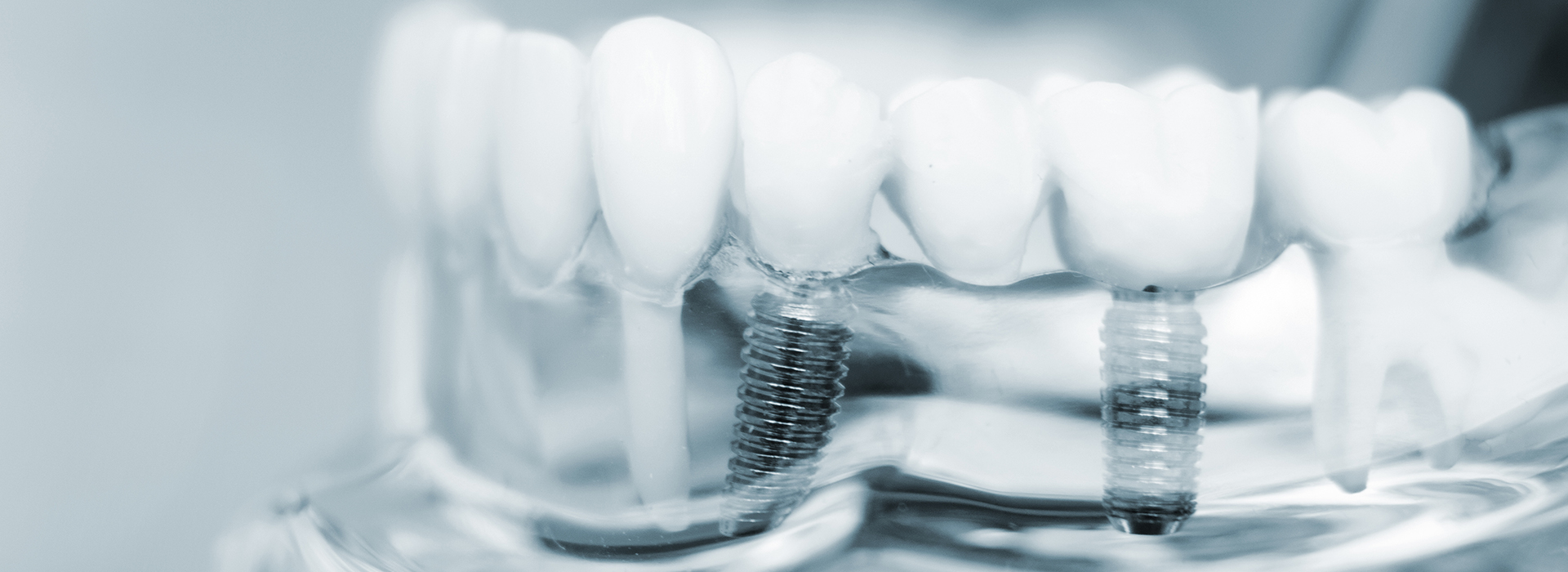 River Place Dental | Intraoral Camera, Sedation Dentistry and Dental Bridge